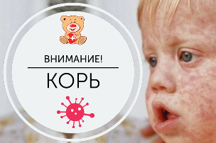 ВНИМАНИЕ: корь! Профилактика кори