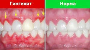 Гингивит у детей: лечение и профилактика