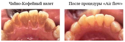 Профессиональная гигиена полости рта